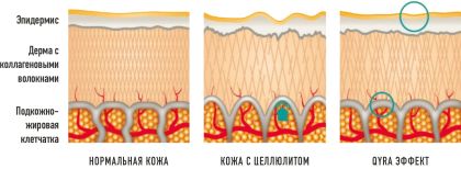 QYRA Целлюлит